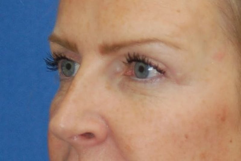Eyelid Surgery Before & After Gallery - Patient 187124 - Image 4