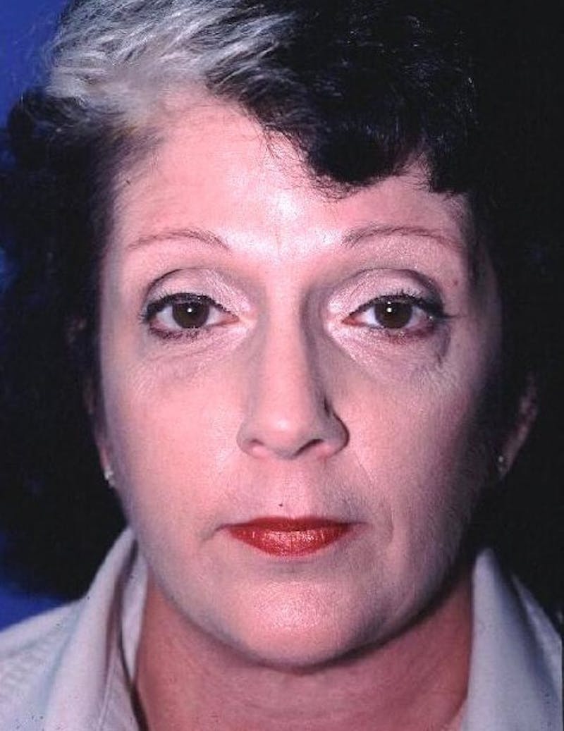 Dr. Cayce Rumsey Before & After Gallery - Patient 244199 - Image 6