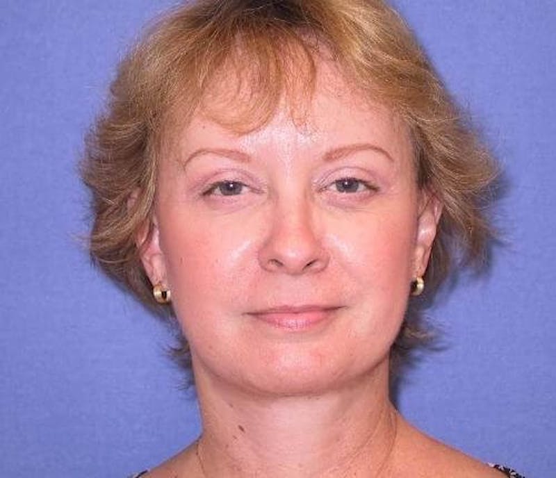 Dr. Cayce Rumsey Before & After Gallery - Patient 349283 - Image 5
