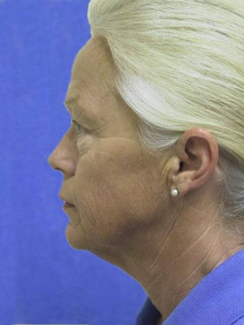 Dr. Cayce Rumsey Before & After Gallery - Patient 188613 - Image 3