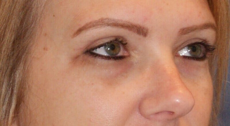 Eyelid Surgery Before & After Gallery - Patient 309296 - Image 4