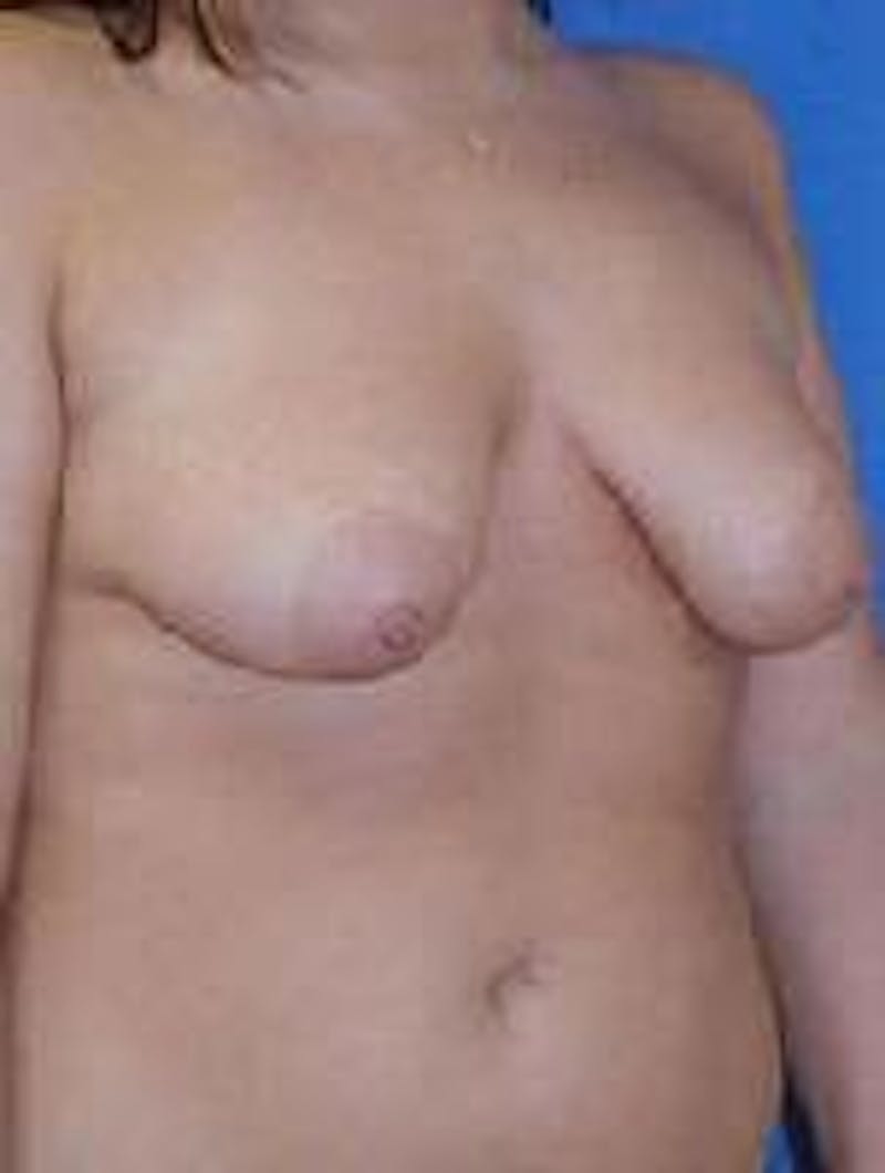 Breast Augmentation Before & After Gallery - Patient 217664 - Image 3