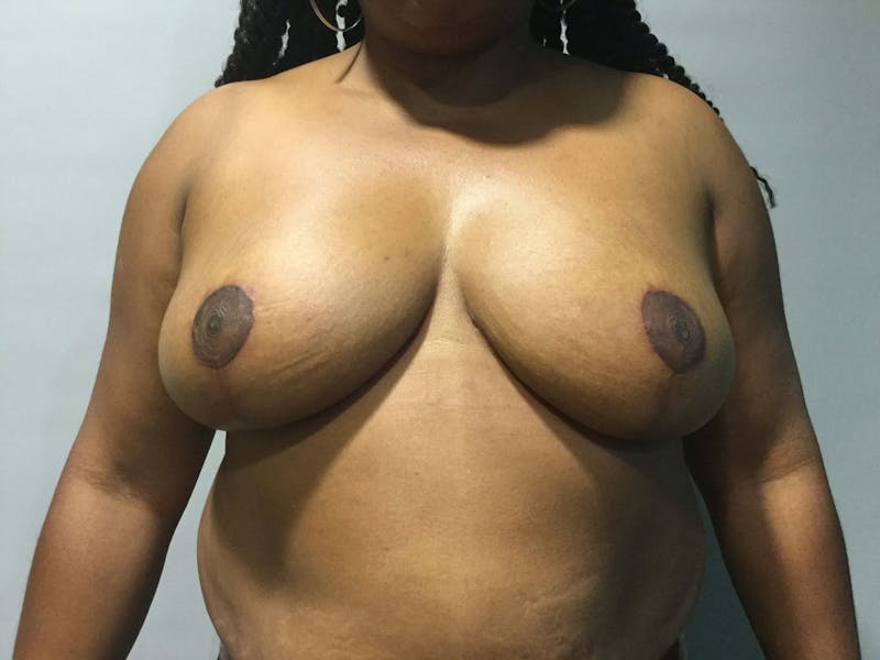 Breast Reduction Before & After Gallery - Patient 100439 - Image 2