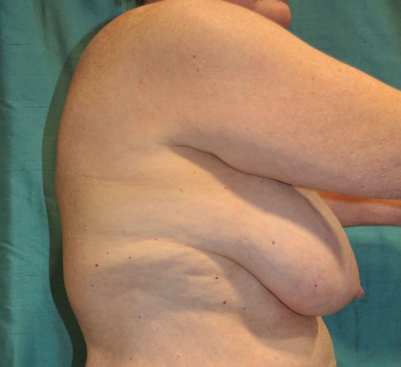 Dr. Erez Sternberg Before & After Gallery - Patient 605859 - Image 3
