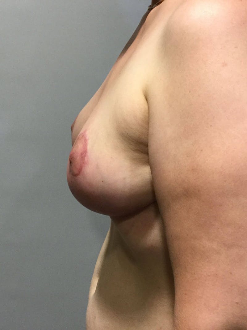 Dr. Erez Sternberg Before & After Gallery - Patient 370374 - Image 4