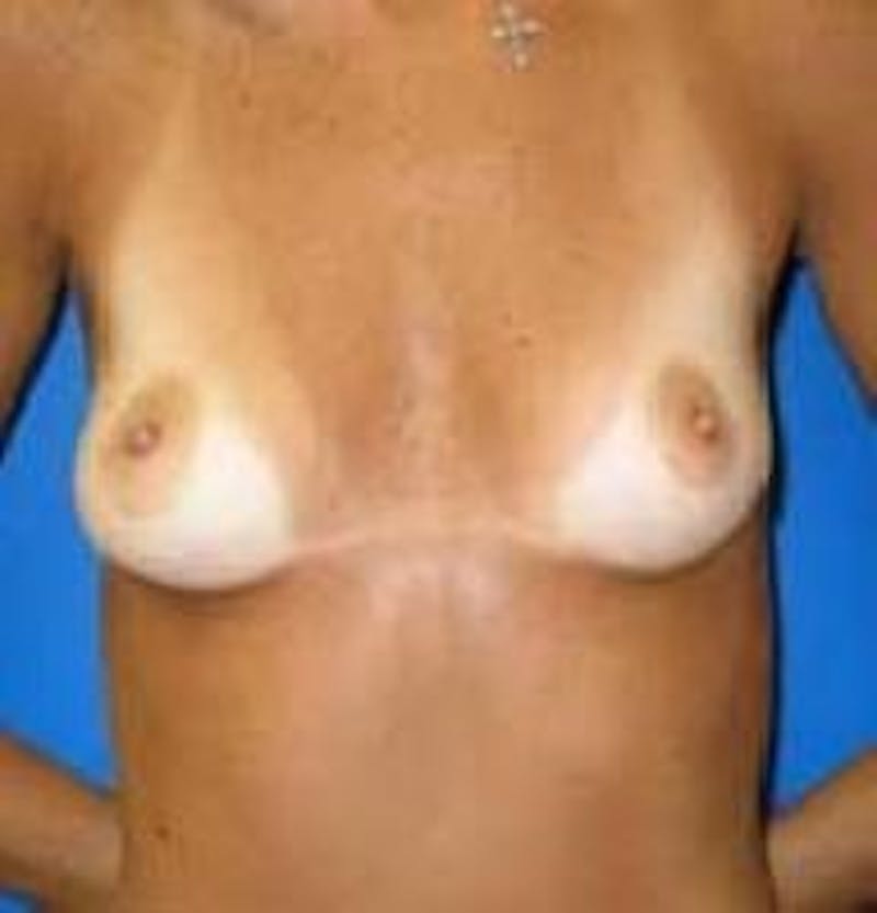 Breast Augmentation Before & After Gallery - Patient 347889 - Image 1