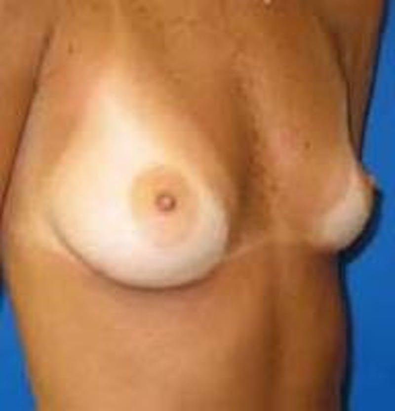Breast Augmentation Before & After Gallery - Patient 347889 - Image 3