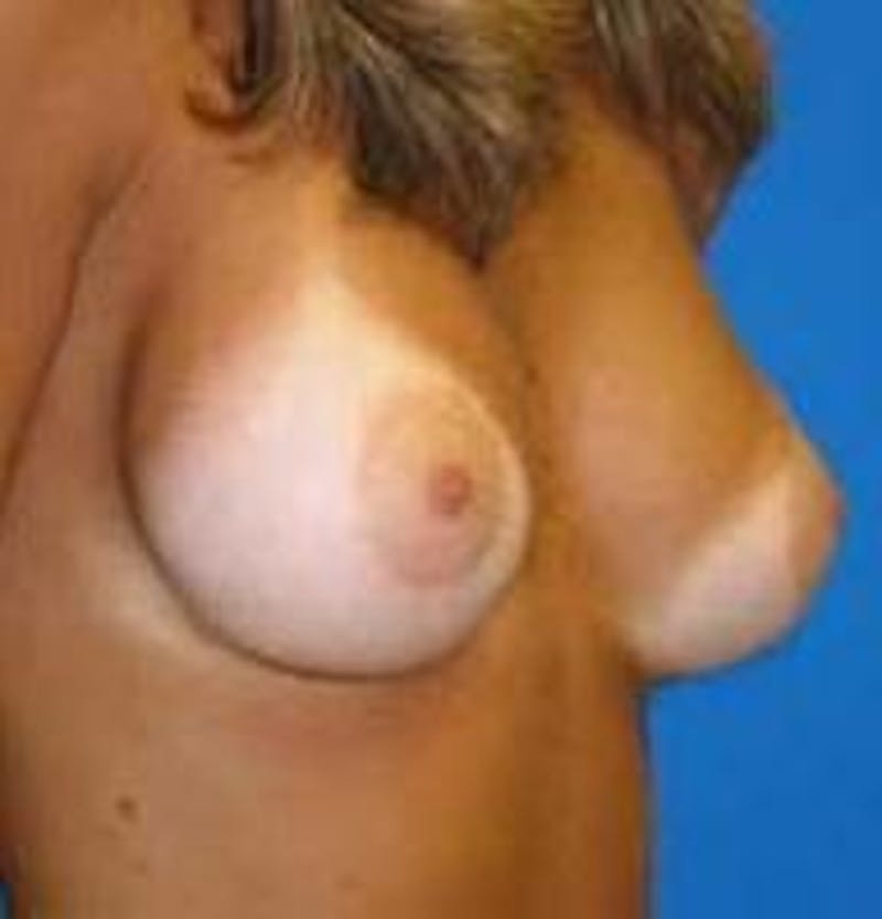 Breast Augmentation Before & After Gallery - Patient 347889 - Image 4