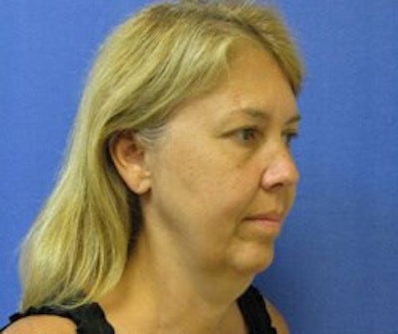 Dr. Cayce Rumsey Before & After Gallery - Patient 151044 - Image 3