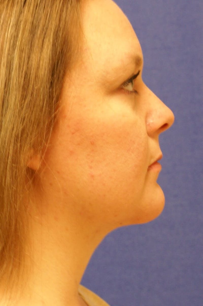 Dr. Cayce Rumsey Before & After Gallery - Patient 103260 - Image 2