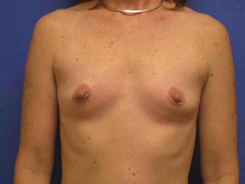 Dr. Cayce Rumsey Before & After Gallery - Patient 293789 - Image 1