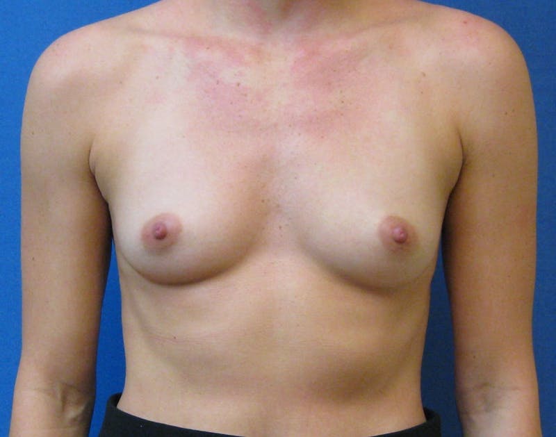 Dr. Cayce Rumsey Before & After Gallery - Patient 368023 - Image 1