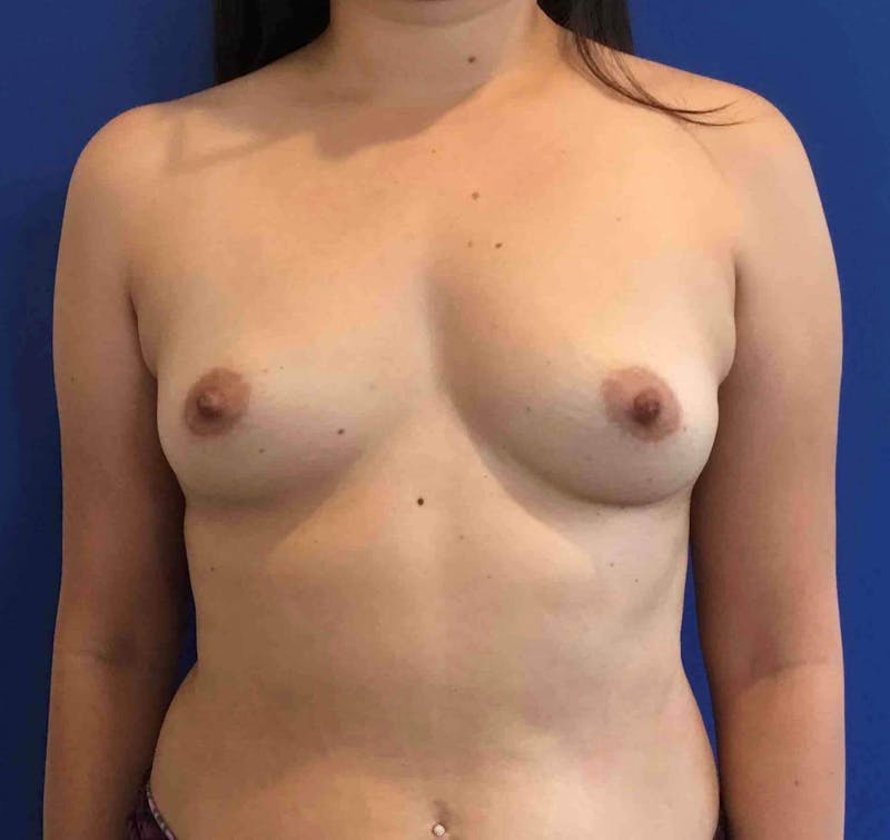 Breast Augmentation Before & After Gallery - Patient 109842 - Image 1