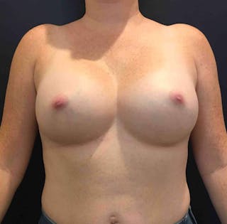 Dr. Cayce Rumsey Before & After Gallery - Patient 127038 - Image 2