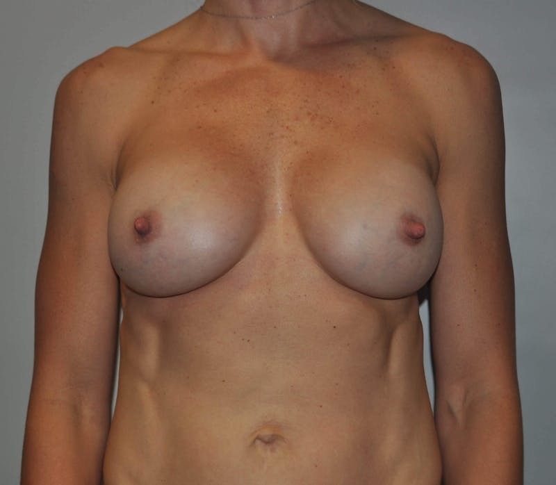 Breast Augmentation Before & After Gallery - Patient 173761 - Image 2