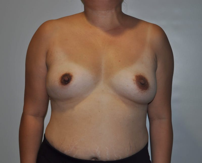 Breast Augmentation Before & After Gallery - Patient 418428 - Image 1
