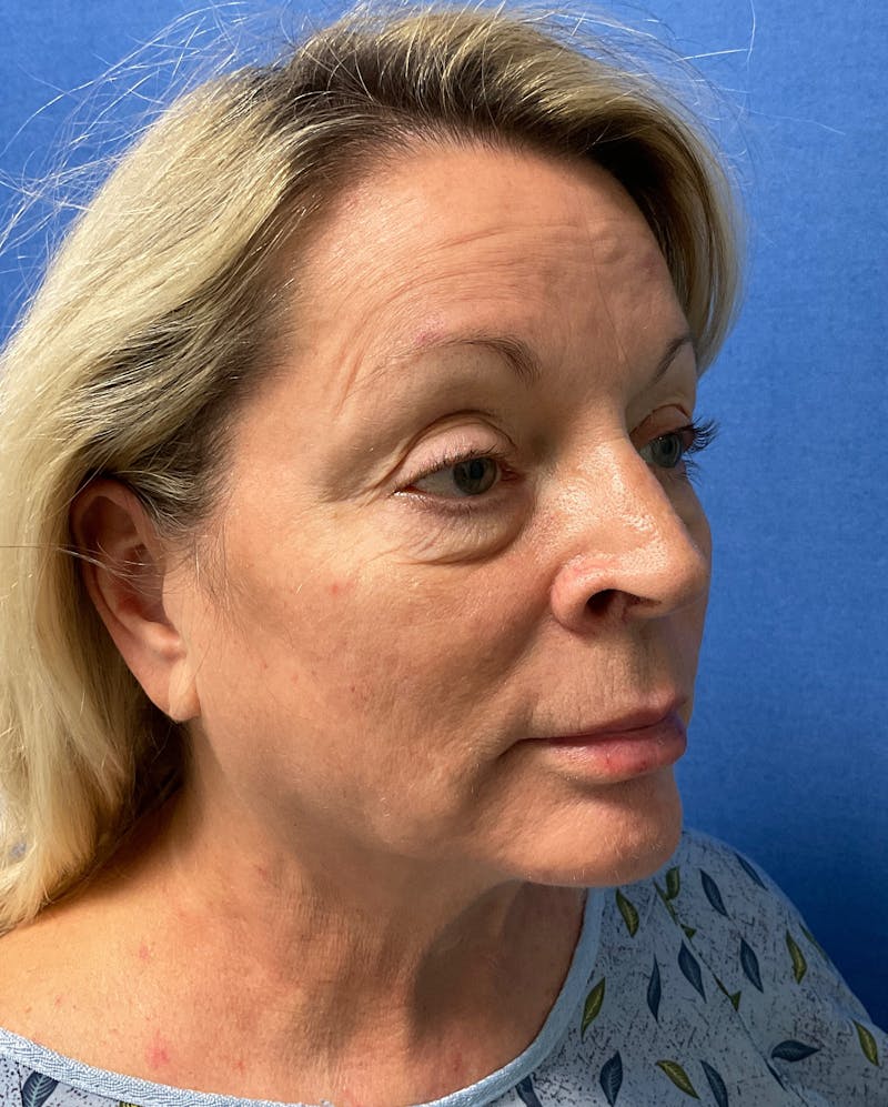 Dr. Chris Bates Before & After Gallery - Patient 211844 - Image 3