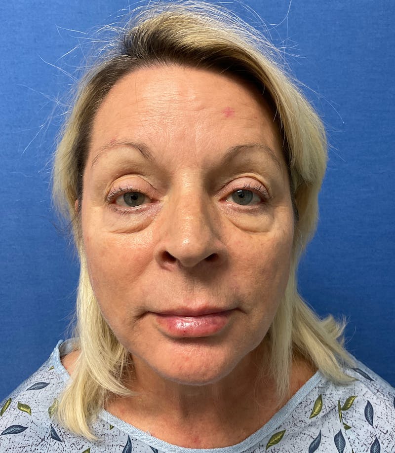 Dr. Chris Bates Before & After Gallery - Patient 211844 - Image 1