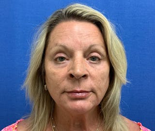 Dr. Chris Bates Before & After Gallery - Patient 211844 - Image 2