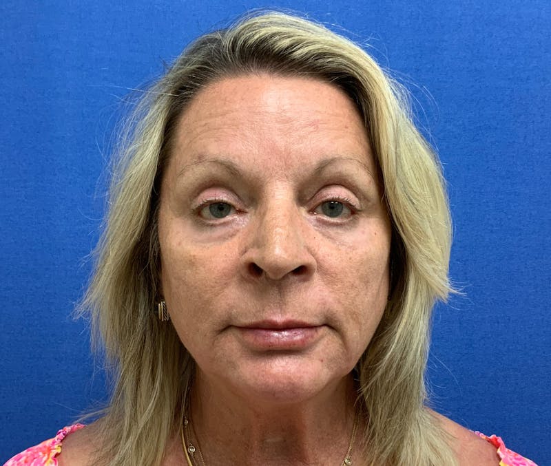Dr. Chris Bates Before & After Gallery - Patient 211844 - Image 2