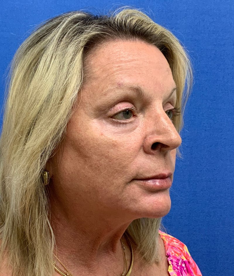 Dr. Chris Bates Before & After Gallery - Patient 211844 - Image 4