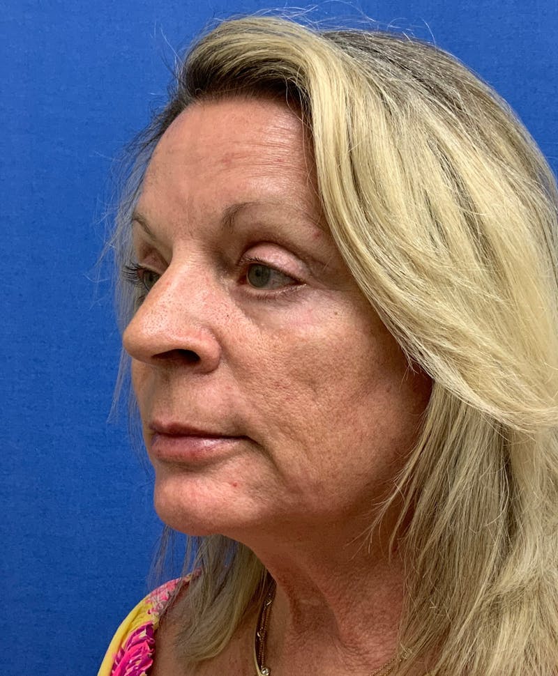 Dr. Chris Bates Before & After Gallery - Patient 211844 - Image 6