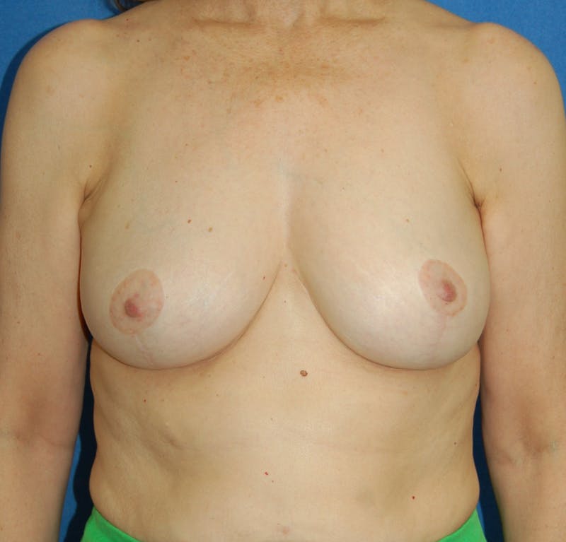 Dr. Robert Burk Before & After Gallery - Patient 166759 - Image 2