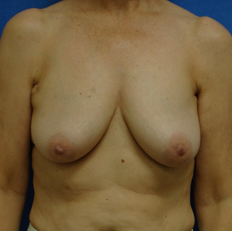 Dr. Robert Burk Before & After Gallery - Patient 166759 - Image 1