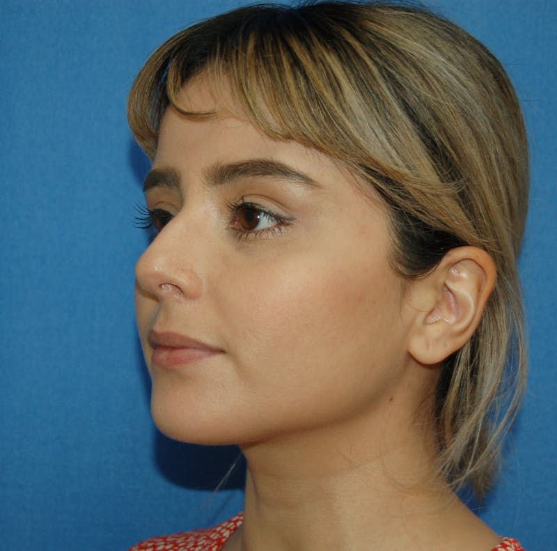 Dr. Robert Burk Before & After Gallery - Patient 212734 - Image 3