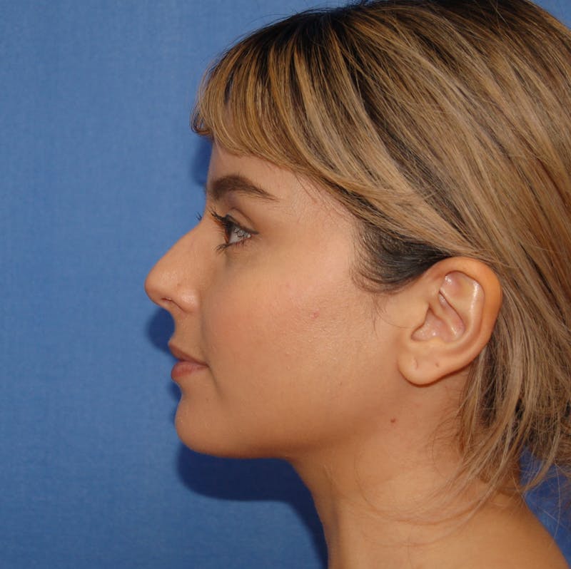 Dr. Robert Burk Before & After Gallery - Patient 212734 - Image 1