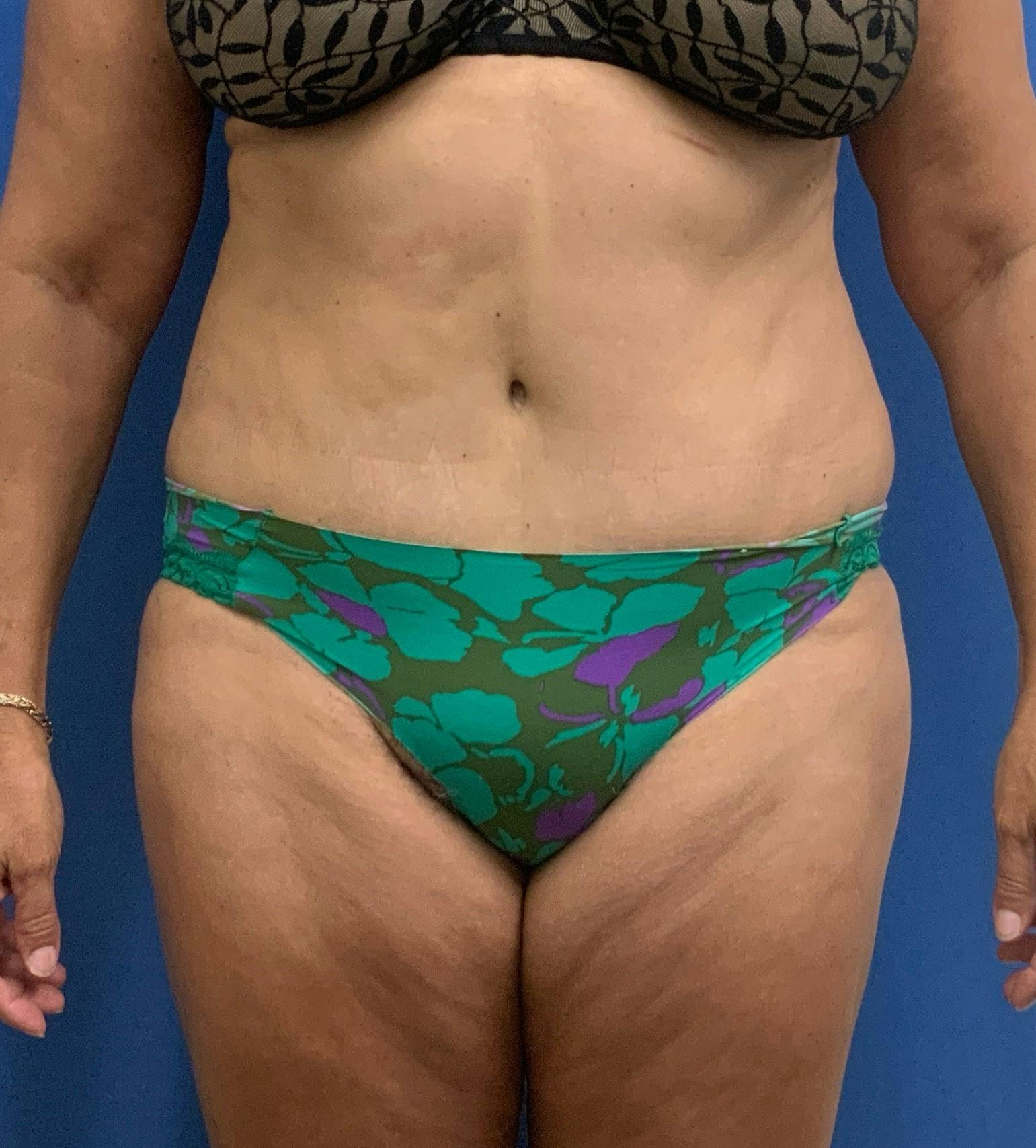 Dr. Robert Burk Before & After Gallery - Patient 159956 - Image 2