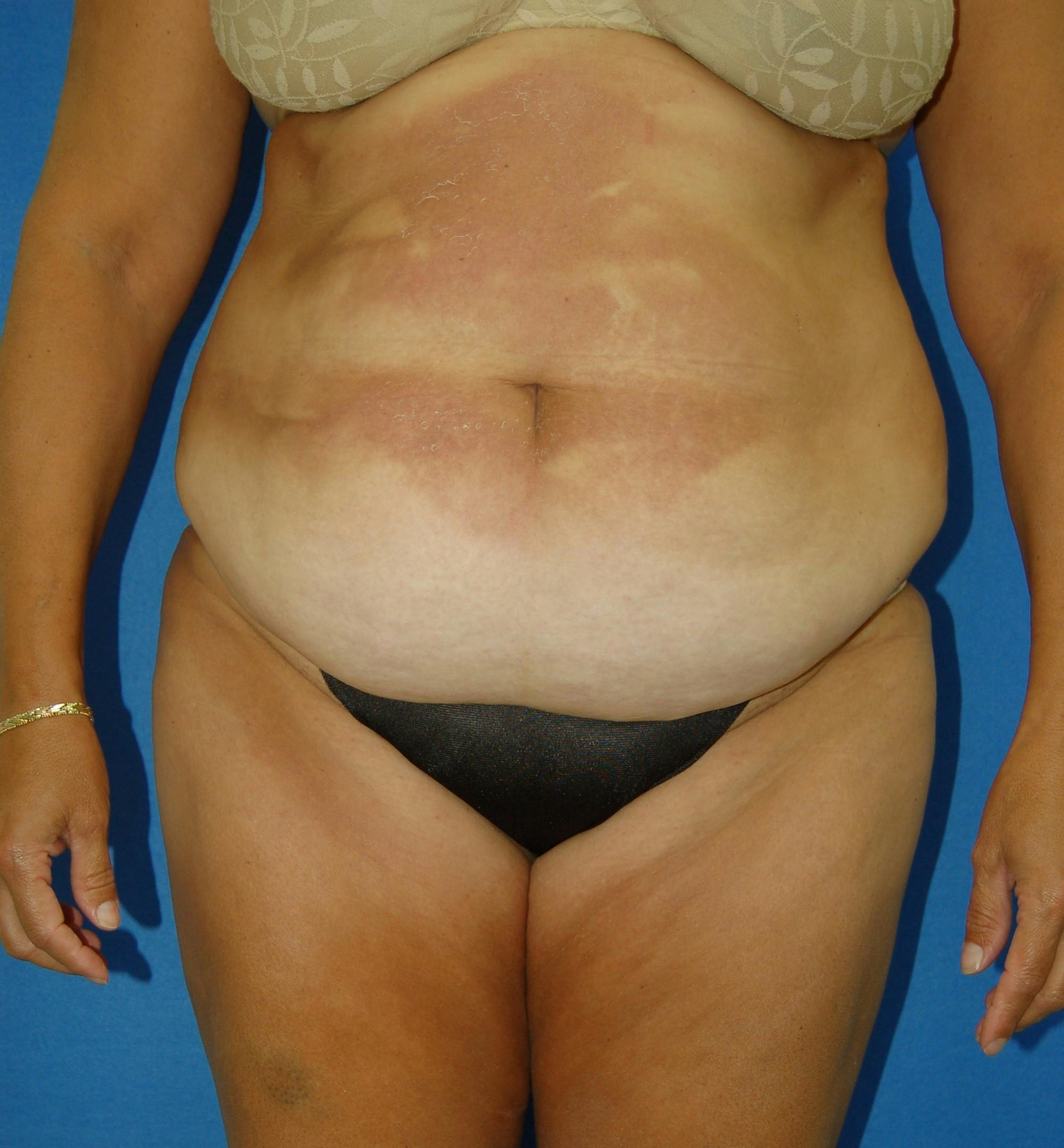 Dr. Robert Burk Before & After Gallery - Patient 159956 - Image 1