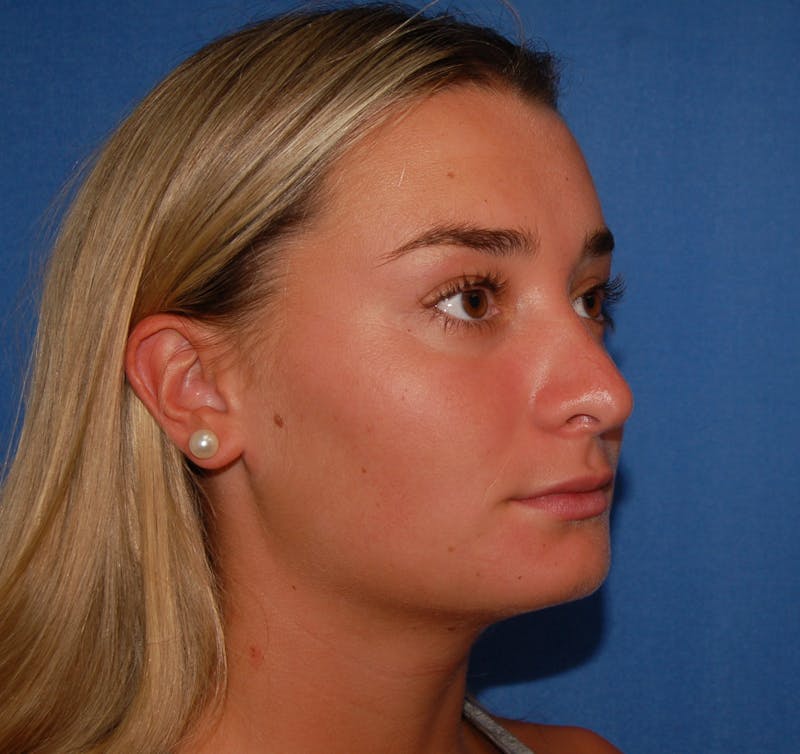 Dr. Robert Burk Before & After Gallery - Patient 380250 - Image 4