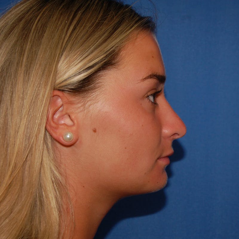 Dr. Robert Burk Before & After Gallery - Patient 380250 - Image 2