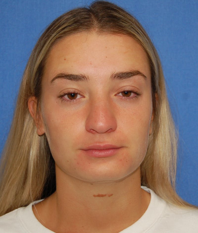 Dr. Robert Burk Before & After Gallery - Patient 380250 - Image 5