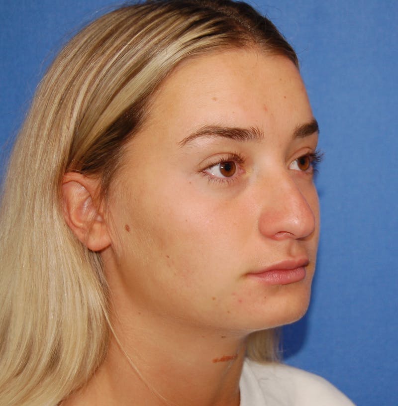 Dr. Robert Burk Before & After Gallery - Patient 380250 - Image 3