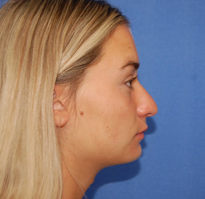 Dr. Robert Burk Before & After Gallery - Patient 380250 - Image 1