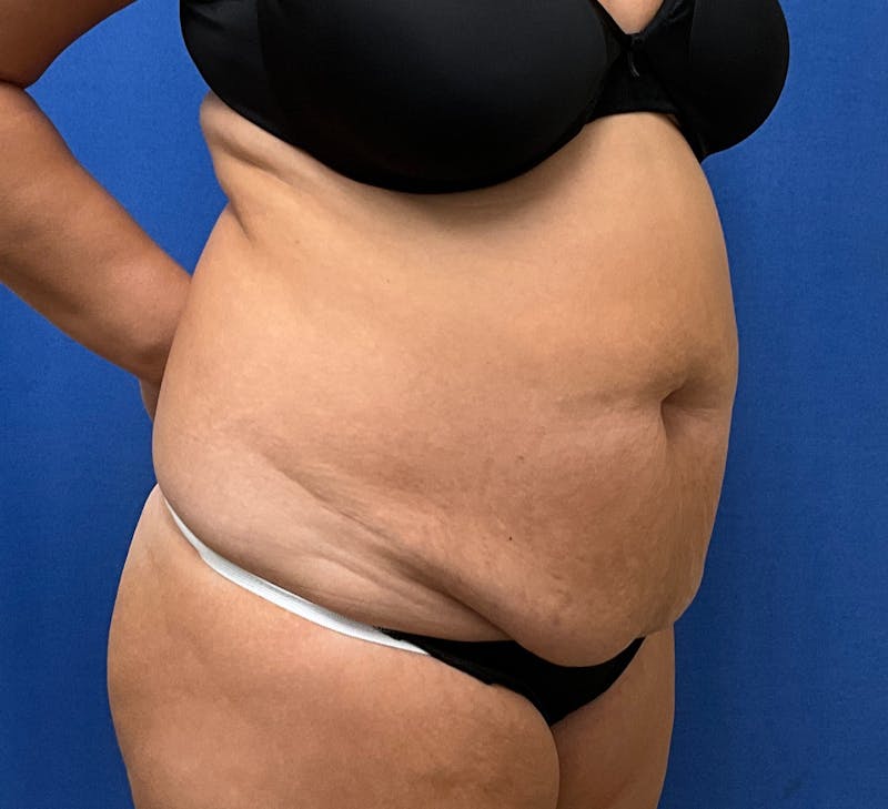 Dr. Ellen Hancock Before & After Gallery - Patient 388585 - Image 3
