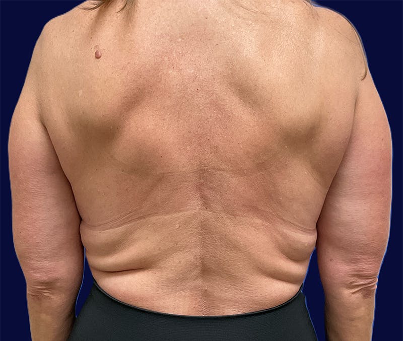 Dr. Chris Bates Before & After Gallery - Patient 259826 - Image 1