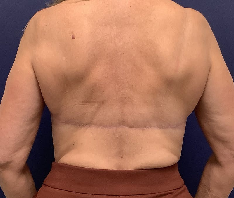 Dr. Chris Bates Before & After Gallery - Patient 259826 - Image 2