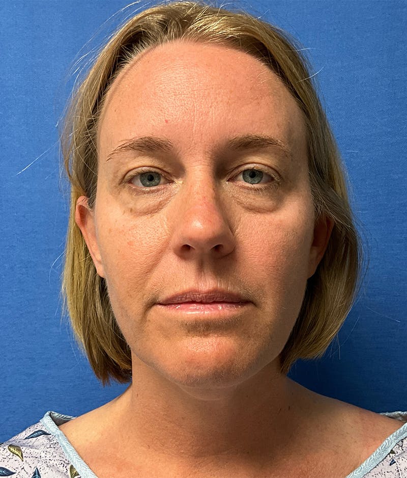 Dr. Chris Bates Before & After Gallery - Patient 286495 - Image 1