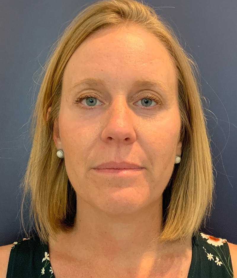 Dr. Chris Bates Before & After Gallery - Patient 286495 - Image 2