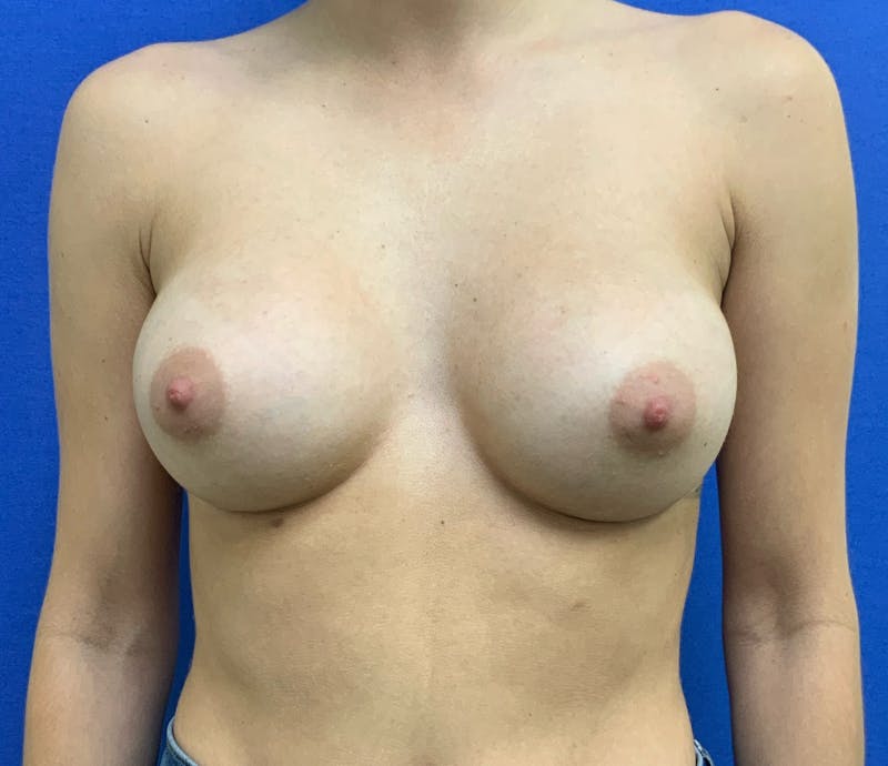 Dr. Hollie Hickman Before & After Gallery - Patient 646069 - Image 2