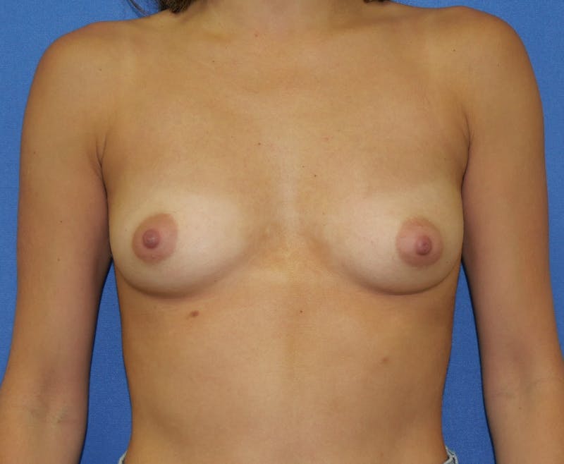 Dr. Hollie Hickman Before & After Gallery - Patient 646069 - Image 1