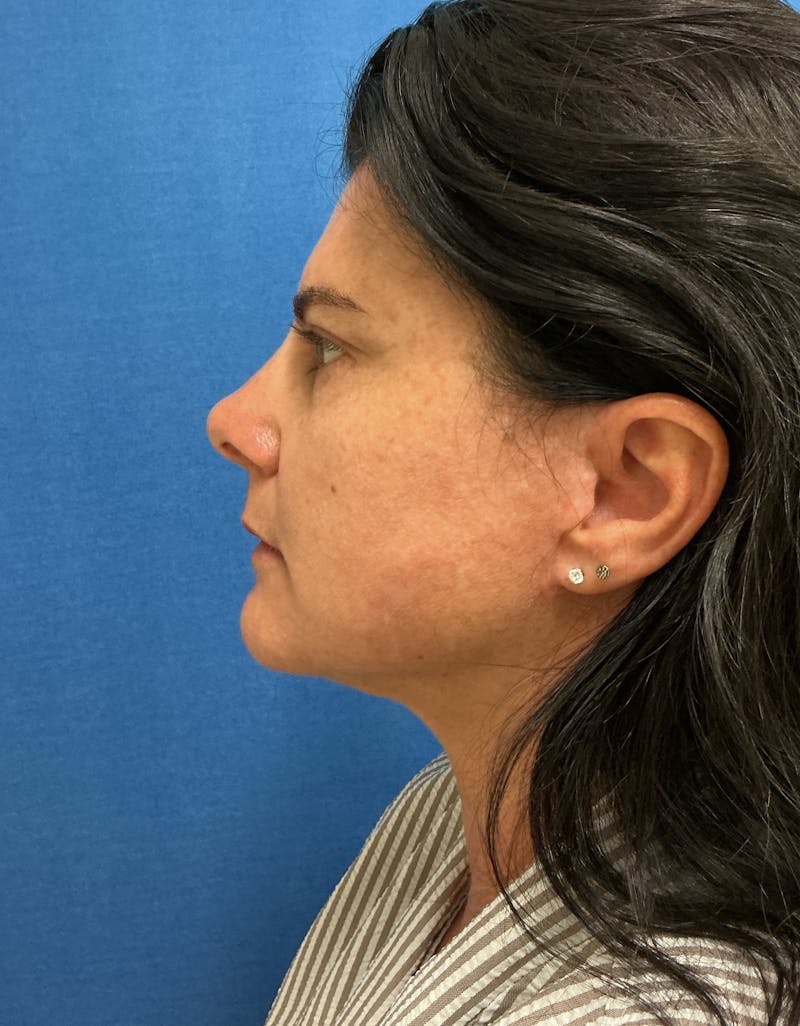 Dr. Matthew Mitchell Before & After Gallery - Patient 951376 - Image 6