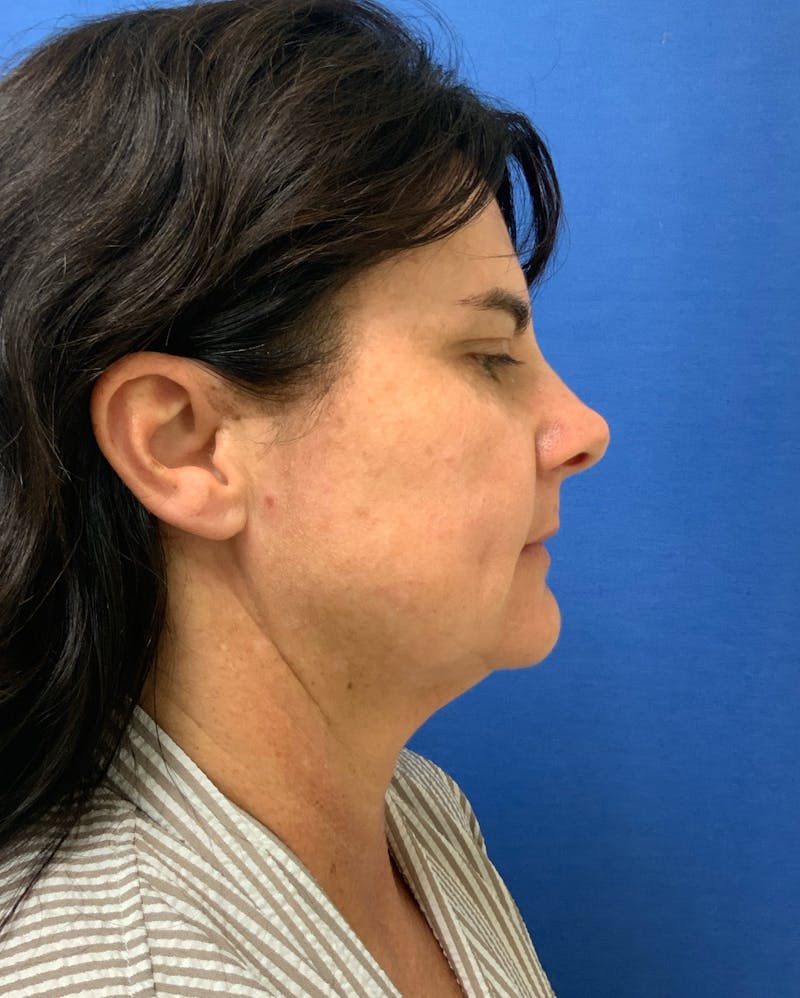 Dr. Matthew Mitchell Before & After Gallery - Patient 951376 - Image 3