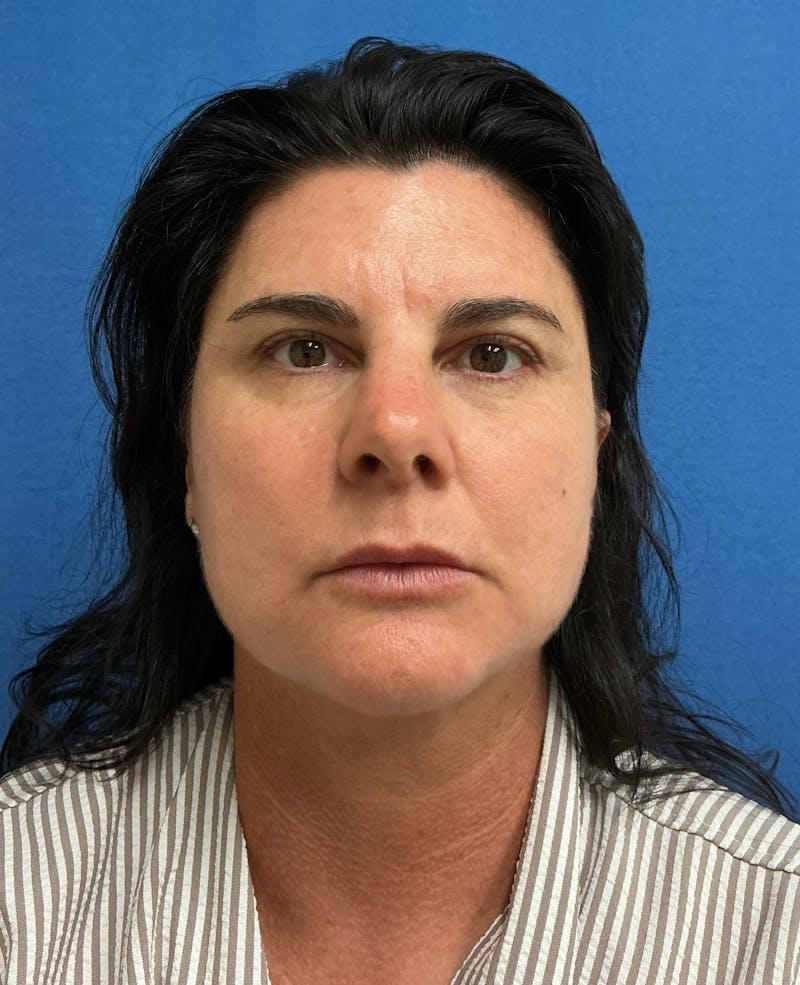Dr. Matthew Mitchell Before & After Gallery - Patient 951376 - Image 2