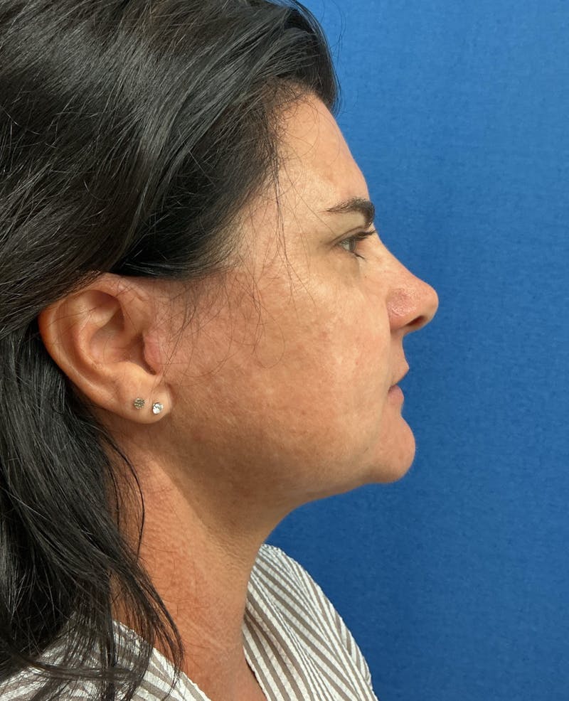 Dr. Matthew Mitchell Before & After Gallery - Patient 951376 - Image 4