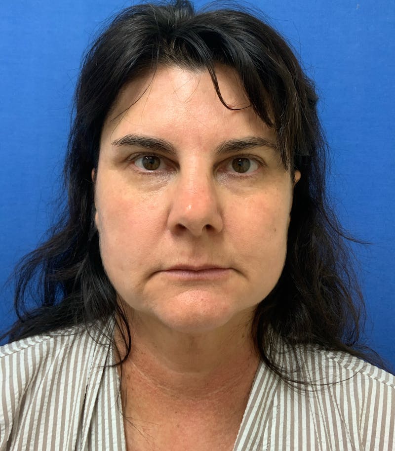 Dr. Matthew Mitchell Before & After Gallery - Patient 951376 - Image 1