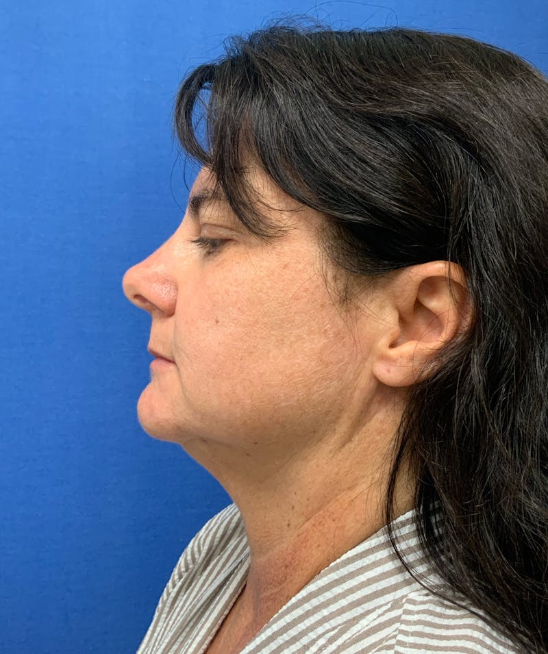 Dr. Matthew Mitchell Before & After Gallery - Patient 951376 - Image 5